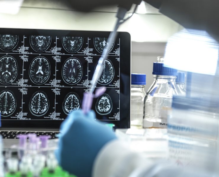 Alzheimers treatment